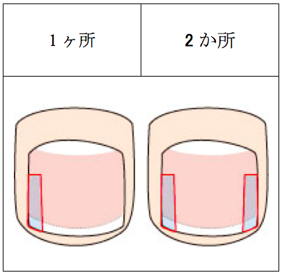 巻き爪の補正費用